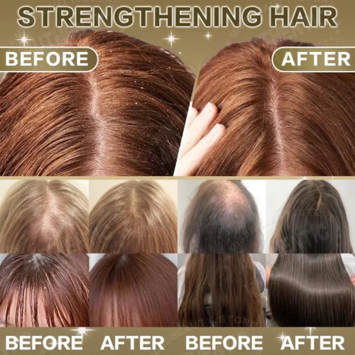 KORMESIC 5% Minoxidil with Biotin